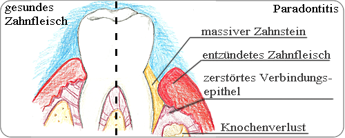Parodontitis Parodontitis