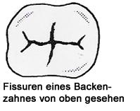 Fissuren Versiegelung