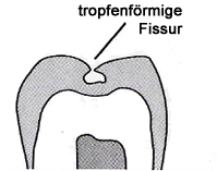 Fissuren Versiegelung