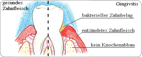 Gingivitis