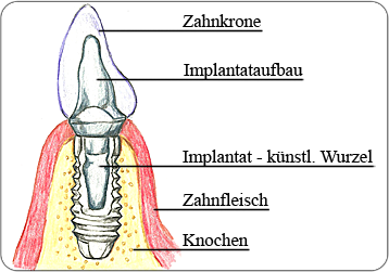 Implantataufbau Skizze